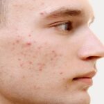 Mụn ở má