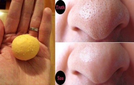 8 cách trị mụn bằng trứng gà luộc ai cũng nên biết 8 cách trị mụn bằng trứng gà luộc ai cũng nên biết