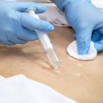 Cấy tinh chất giảm béo