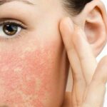 mỹ phẩm dễ gây dị ứng