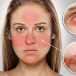 Dị ứng mỹ phẩm ở mặt