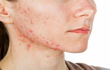 Dị ứng mỹ phẩm – Dấu hiệu nhận biết và nên khắc phục ra sao? Dị ứng mỹ phẩm – Dấu hiệu nhận biết và nên khắc phục ra sao?