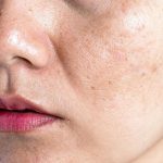 Nguyên nhân gây nám, tàn nhang