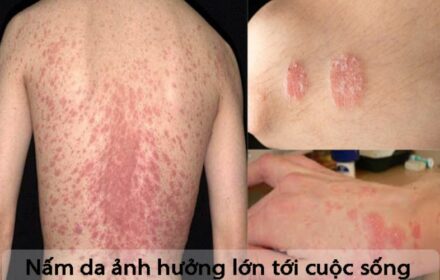 Những cách loại bỏ nam da cực kỳ hiệu quả Những cách loại bỏ nam da cực kỳ hiệu quả