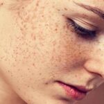 rối loạn sắc tố ở trên da