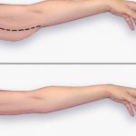 tay to, bắp tay, vai, nách nhiều mỡ