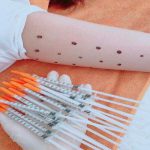 tiêm tan mỡ bắp tay