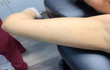 Có nên tiêm tan mỡ bắp tay hay không? Có nên tiêm tan mỡ bắp tay hay không?