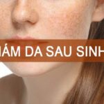 Trị nám sau sinh