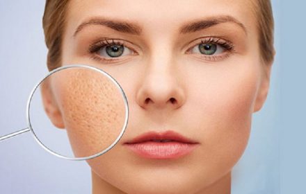 Cập nhật những phương pháp trị sẹo rỗ cực kỳ an toàn, siêu hiệu quả Cập nhật những phương pháp trị sẹo rỗ cực kỳ an toàn, siêu hiệu quả