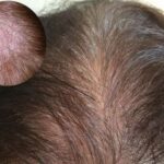 chân tóc có mụn mủ