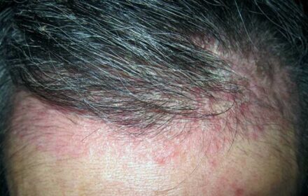 LÝ GIẢI VÌ SAO CHÂN TÓC CÓ MỤN MỦ LÝ GIẢI VÌ SAO CHÂN TÓC CÓ MỤN MỦ