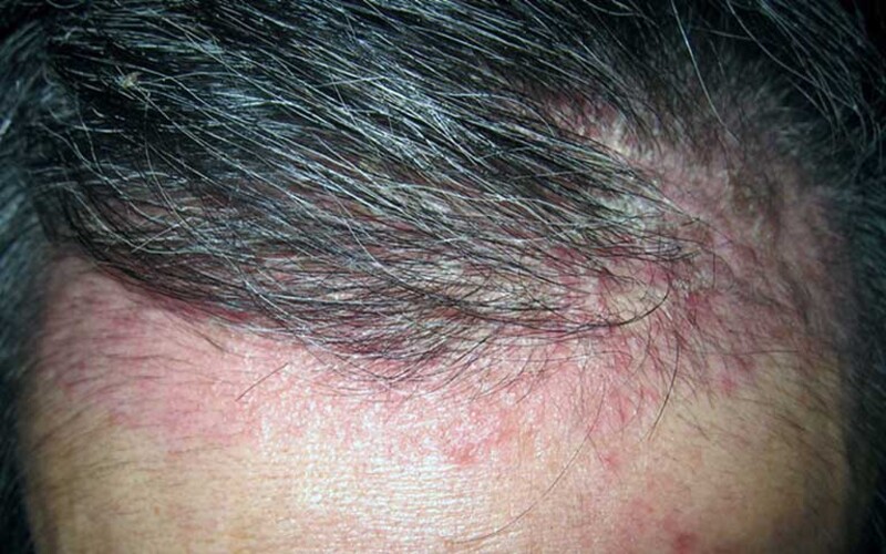 Viêm nang lông ở da đầu