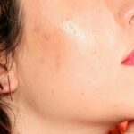 Kích ứng da mặt