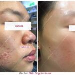 Liệu trình trị sẹo rỗ giá bao nhiêu