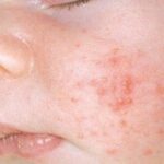 Mụn kê ở trẻ sơ sinh