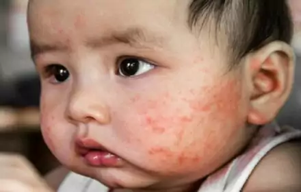 Hiểu đúng về mụn kê ở trẻ sơ sinh và cách điều trị hiệu quả Hiểu đúng về mụn kê ở trẻ sơ sinh và cách điều trị hiệu quả