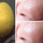 Cách nặn mụn đầu đen