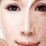 điều trị nám, tàn nhang