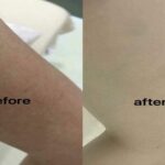 Trị viêm nang lông