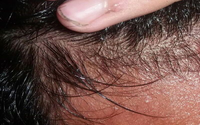điều trị viêm nang lông da đầu
