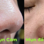 Mụn cám, mụn đầu đen