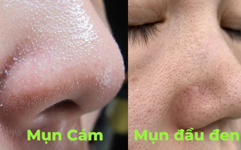 Mụn cám, mụn đầu đen