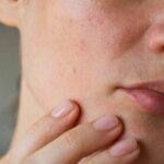 Làn da khô sần sùi