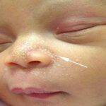 các loại mụn ở trẻ sơ sinh