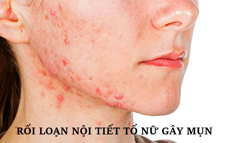 Rối loạn nội tiết tố