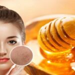 trị mụn bằng mật ong