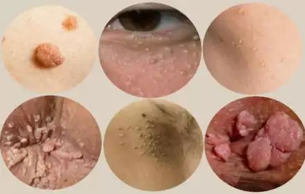 Chia sẻ 5 cách trị mụn thịt dứt điểm tại nhà hiệu quả nhất Chia sẻ 5 cách trị mụn thịt dứt điểm tại nhà hiệu quả nhất