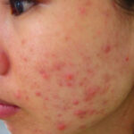 Cách trị mụn tuổi dậy thì