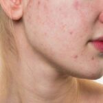 Mụn đỏ không nhân