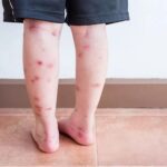 Sẹo thâm ở chân