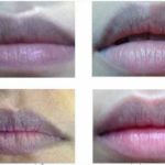 môi bị thâm đen