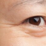 căng da vùng mắt