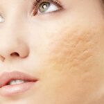 Sẹo rỗ là vết lõm