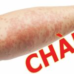 Chàm là bệnh da liễu