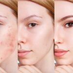 chăm sóc da sau khi trị mụn