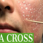 Chấm TCA trị sẹo rỗ