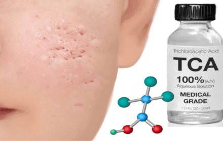 Chấm TCA là gì? Chấm TCA trị sẹo rỗ có mang lại hiệu quả như lời đồn? Chấm TCA là gì? Chấm TCA trị sẹo rỗ có mang lại hiệu quả như lời đồn?
