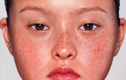 Những cách trị dứt điểm đồi mồi da nhanh chóng Những cách trị dứt điểm đồi mồi da nhanh chóng