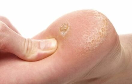 Những cách trị mụn hạt cơm đơn giản ngay tại nhà Những cách trị mụn hạt cơm đơn giản ngay tại nhà