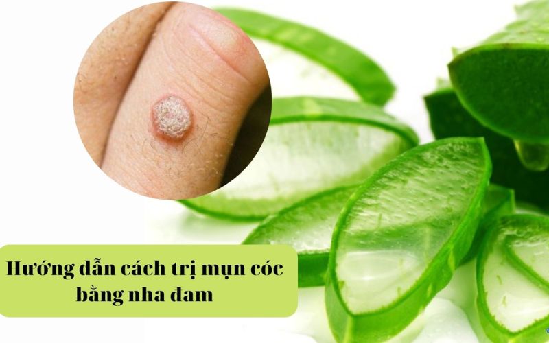 Trị mụn cơm