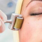 Lăn kim trị sẹo rỗ