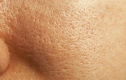 Bật mí 5 cách khiến se khít lỗ chân lông to hiệu quả Bật mí 5 cách khiến se khít lỗ chân lông to hiệu quả