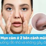 mụn cám ở mũi