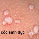 Mụn cóc sinh dục