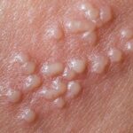 Mụn nước phồng rộp